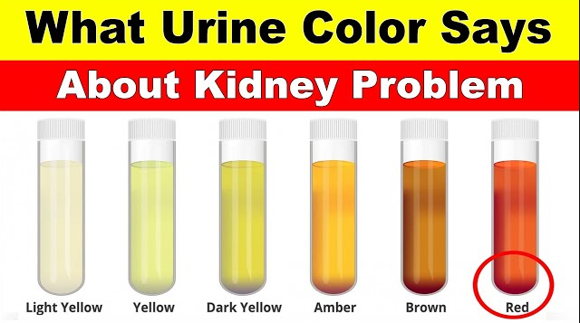 When Your Kidneys Are Failing, What Color Is Your Urine?